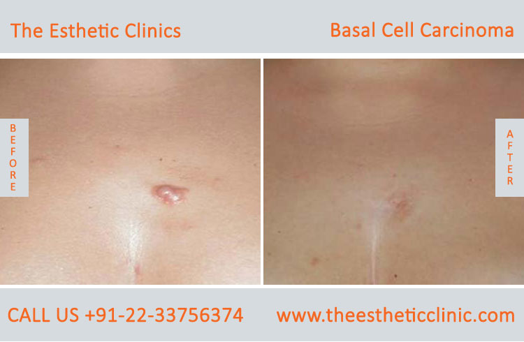 Basal Cell Carcinoma Treatment Surgery before after photos in mumbai india (1)
